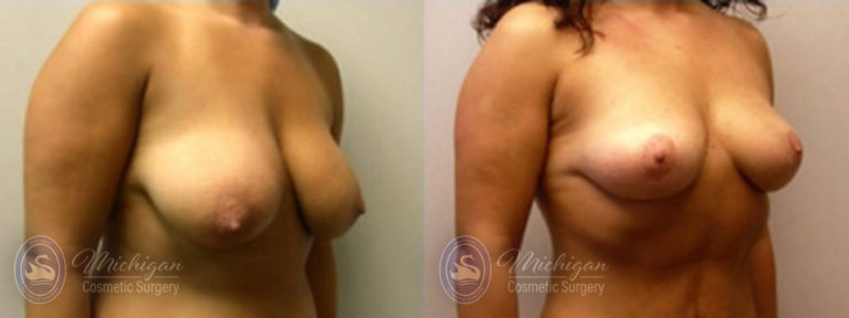 Breast Lift Before and After Photo by Dr. Awada in Southfield Michigan