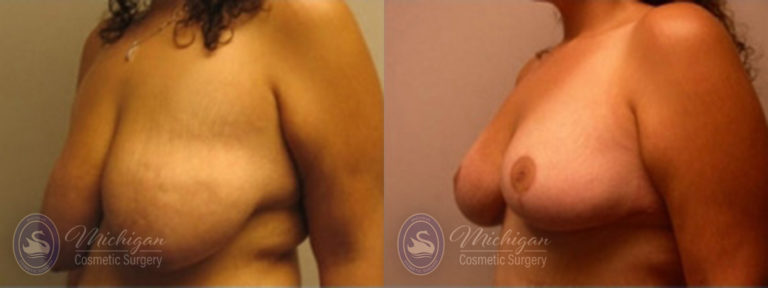 Breast Lift Before and After Photo by Dr. Awada in Southfield Michigan