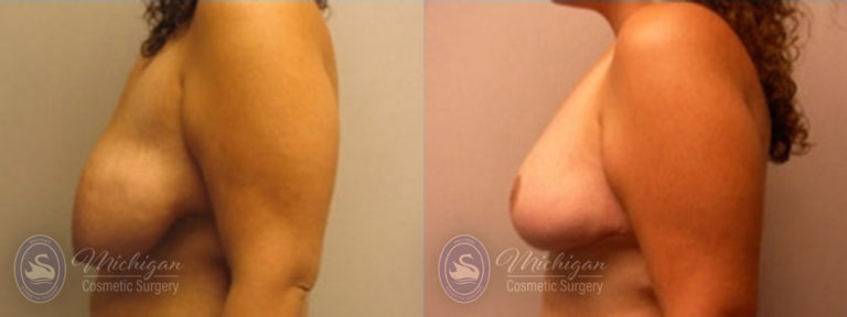 Breast Lift Before and After Photo by Dr. Awada in Southfield Michigan