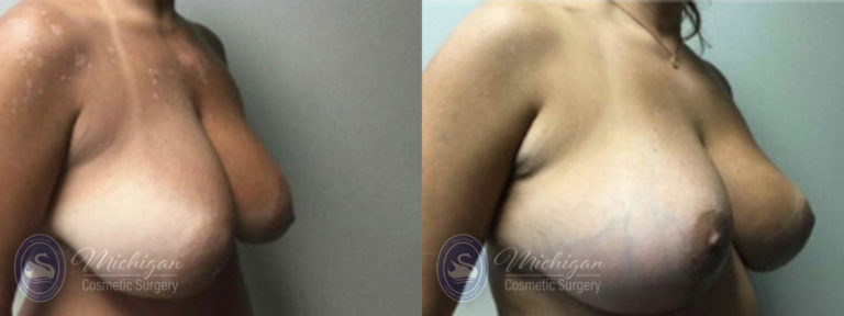 Breast Lift Before and After Photo by Dr. Awada in Southfield Michigan