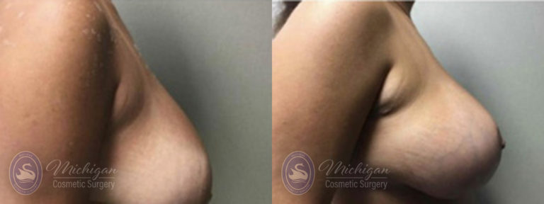 Breast Lift Before and After Photo by Dr. Awada in Southfield Michigan