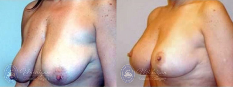 Breast Lift Before and After Photo by Dr. Awada in Southfield Michigan