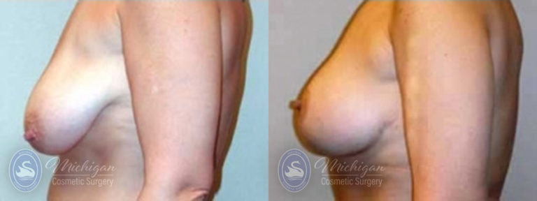 Breast Lift Before and After Photo by Dr. Awada in Southfield Michigan