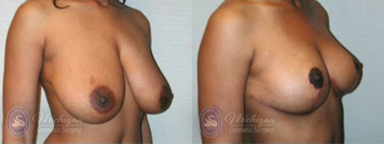 Breast Lift Before and After Photo by Dr. Awada in Southfield Michigan