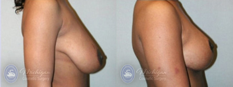 Breast Lift Before and After Photo by Dr. Awada in Southfield Michigan