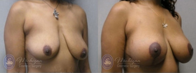 Breast Lift Before and After Photo by Dr. Awada in Southfield Michigan