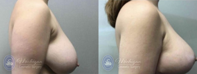 Breast Lift Before and After Photo by Dr. Awada in Southfield Michigan