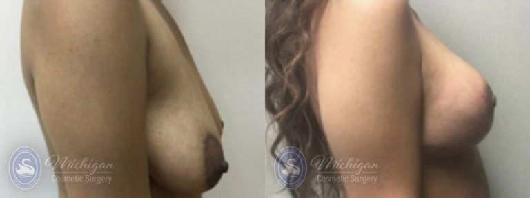 Breast Lift Before and After Photo by Dr. Awada in Southfield Michigan