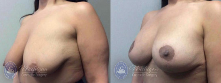 Breast Lift Before and After Photo by Dr. Awada in Southfield Michigan