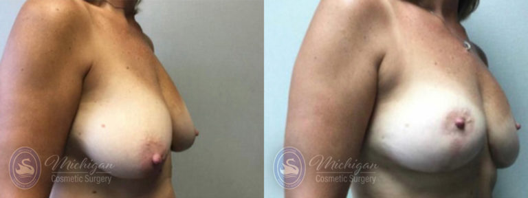 Breast Lift Before and After Photo by Dr. Awada in Southfield Michigan
