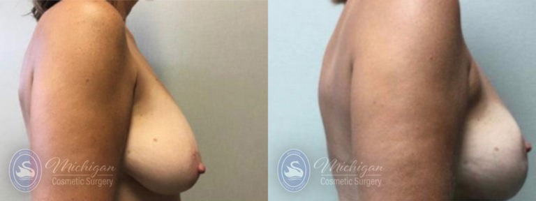 Breast Lift Before and After Photo by Dr. Awada in Southfield Michigan