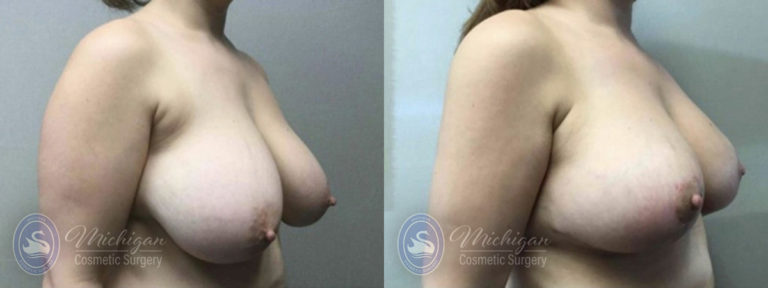 Breast Lift Before and After Photo by Dr. Awada in Southfield Michigan