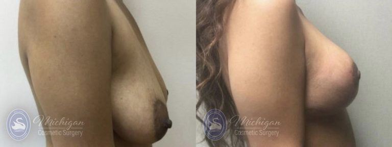 Breast Lift Before and After Photo by Dr. Awada in Southfield Michigan