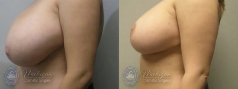 Breast Reduction Before and After Photo by Dr. Awada in Southfield Michigan