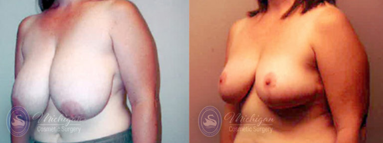 Breast Reduction Before and After Photo by Dr. Awada in Southfield Michigan