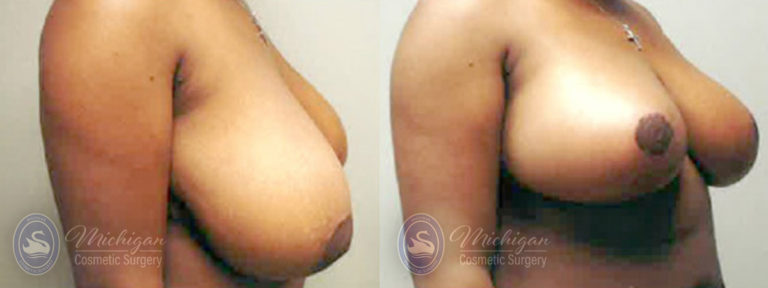 Breast Reduction Before and After Photo by Dr. Awada in Southfield Michigan