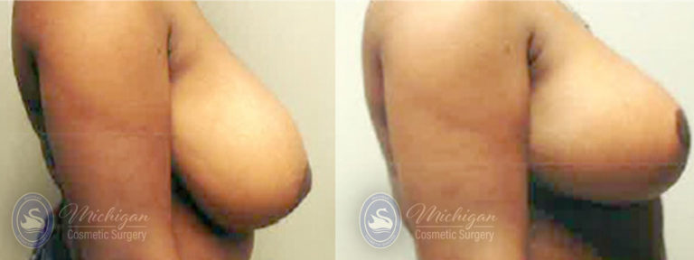 Breast Reduction Before and After Photo by Dr. Awada in Southfield Michigan