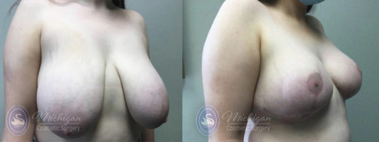 Breast Reduction Before and After Photo by Dr. Awada in Southfield Michigan