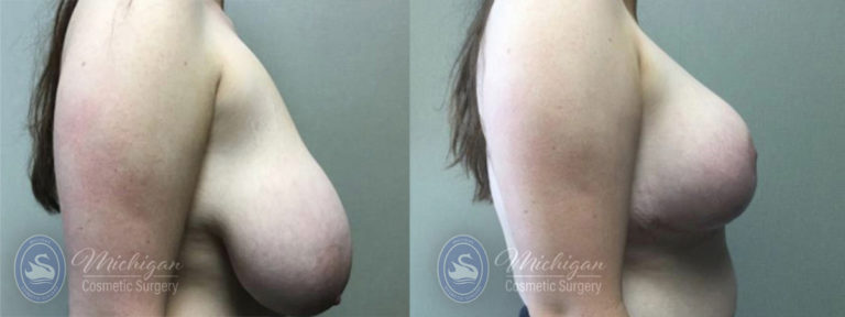 Breast Reduction Before and After Photo by Dr. Awada in Southfield Michigan