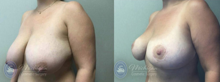 Breast Reduction Before and After Photo by Dr. Awada in Southfield Michigan