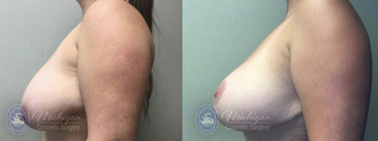 Breast Reduction Before and After Photo by Dr. Awada in Southfield Michigan
