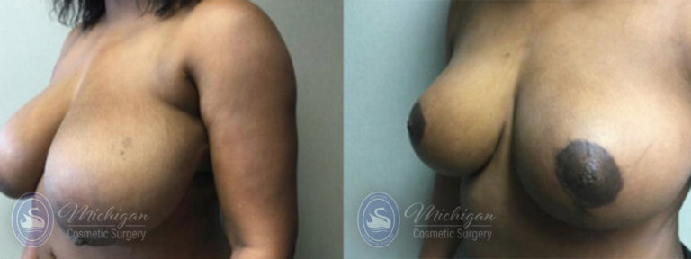 Breast Reduction Before and After Photo by Dr. Awada in Southfield Michigan