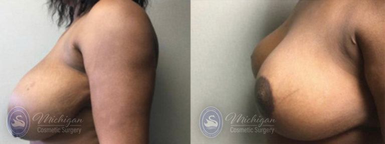 Breast Reduction Before and After Photo by Dr. Awada in Southfield Michigan