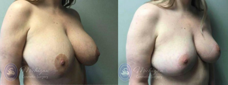 Breast Reduction Before and After Photo by Dr. Awada in Southfield Michigan