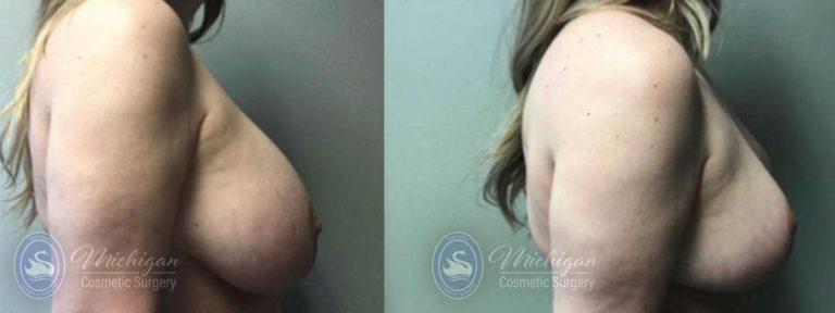 Breast Reduction Before and After Photo by Dr. Awada in Southfield Michigan