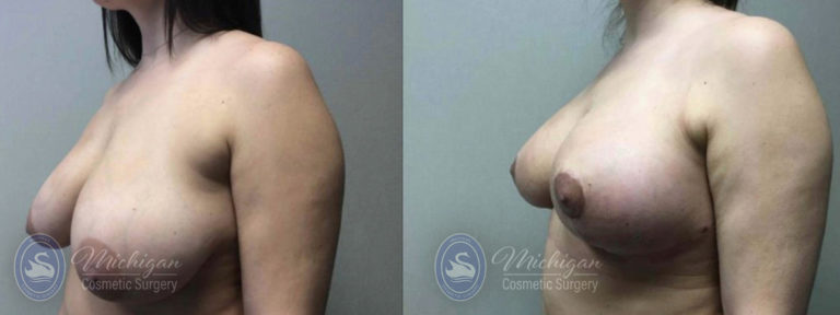 Breast Reduction Before and After Photo by Dr. Awada in Southfield Michigan