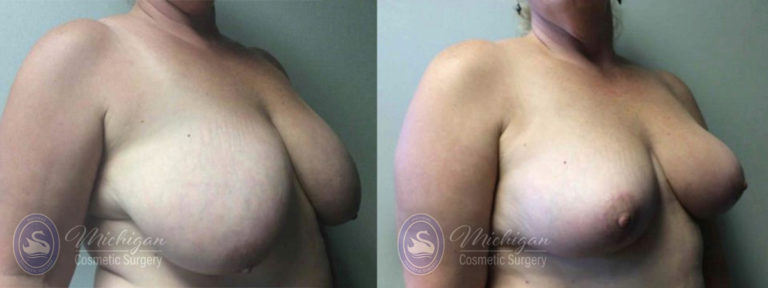 Breast Reduction Before and After Photo by Dr. Awada in Southfield Michigan