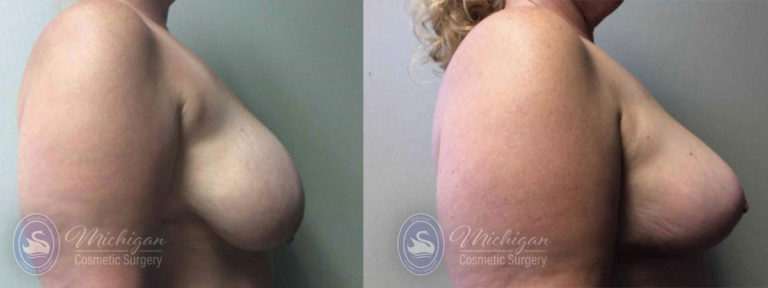 Breast Reduction Before and After Photo by Dr. Awada in Southfield Michigan