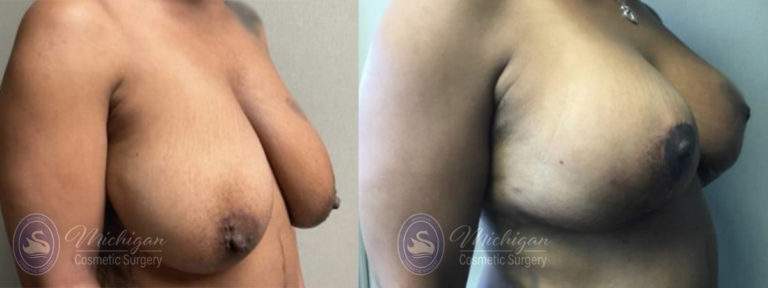 Breast Reduction Before and After Photo by Dr. Awada in Southfield Michigan