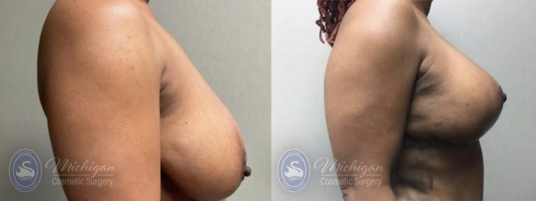 Breast Reduction Before and After Photo by Dr. Awada in Southfield Michigan
