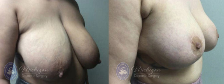 Breast Reduction Before and After Photo by Dr. Awada in Southfield Michigan