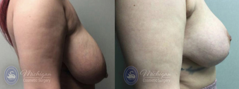 Breast Reduction Before and After Photo by Dr. Awada in Southfield Michigan