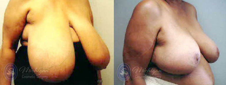 Breast Reduction Before and After Photo by Dr. Awada in Southfield Michigan