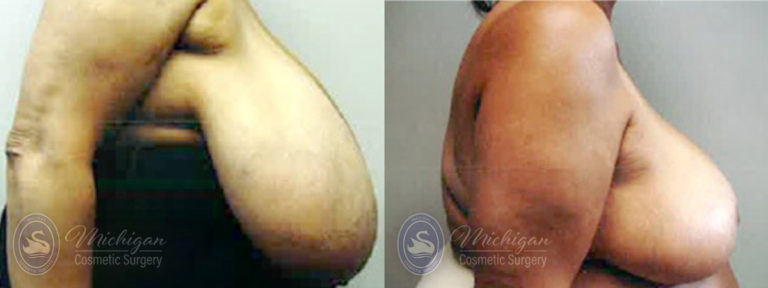Breast Reduction Before and After Photo by Dr. Awada in Southfield Michigan