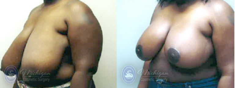 Breast Reduction Before and After Photo by Dr. Awada in Southfield Michigan