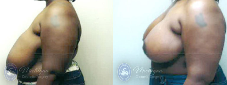 Breast Reduction Before and After Photo by Dr. Awada in Southfield Michigan