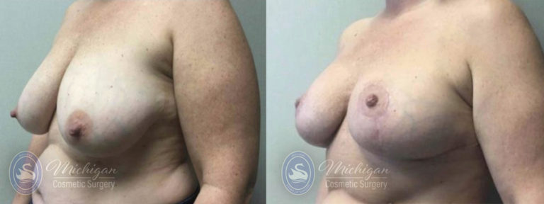 Breast Reduction Before and After Photo by Dr. Awada in Southfield Michigan