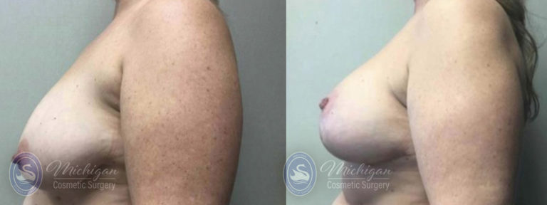 Breast Reduction Before and After Photo by Dr. Awada in Southfield Michigan