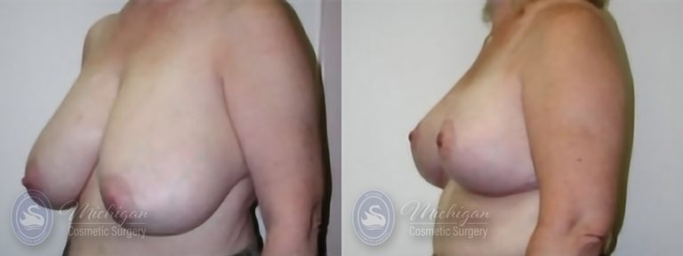Breast Reduction Before and After Photo by Dr. Awada in Southfield Michigan