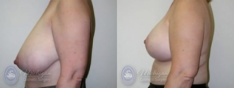 Breast Reduction Before and After Photo by Dr. Awada in Southfield Michigan