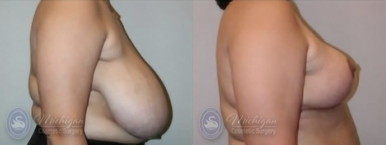 Breast Reduction Before and After Photo by Dr. Awada in Southfield Michigan