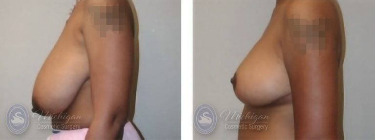 Breast Reduction Before and After Photo by Dr. Awada in Southfield Michigan