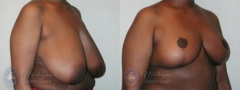 Breast Reduction Before and After Photo by Dr. Awada in Southfield Michigan