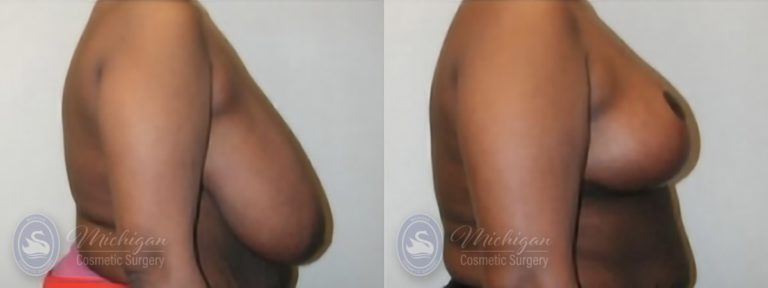 Breast Reduction Before and After Photo by Dr. Awada in Southfield Michigan