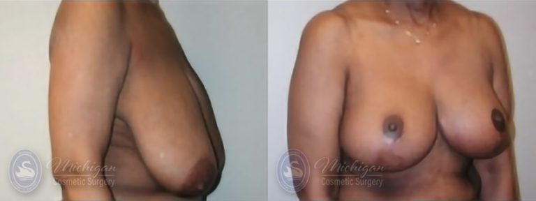 Breast Reduction Before and After Photo by Dr. Awada in Southfield Michigan