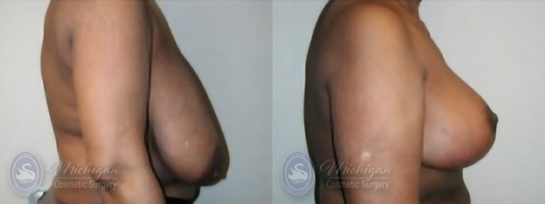 Breast Reduction Before and After Photo by Dr. Awada in Southfield Michigan